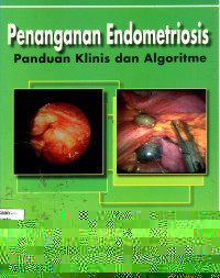 Penanganaan Endometriosis  panduan klinis dan algoritme